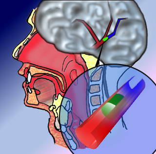 Accidente cerebro vascular